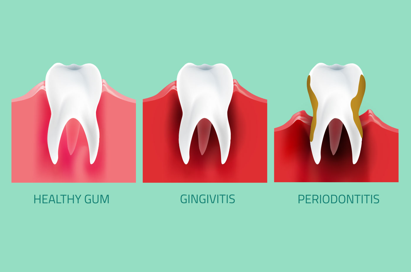 gum-disease