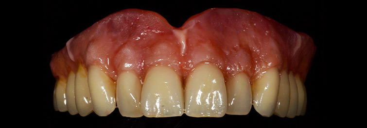 Ilfracombe_Dentures_Elite