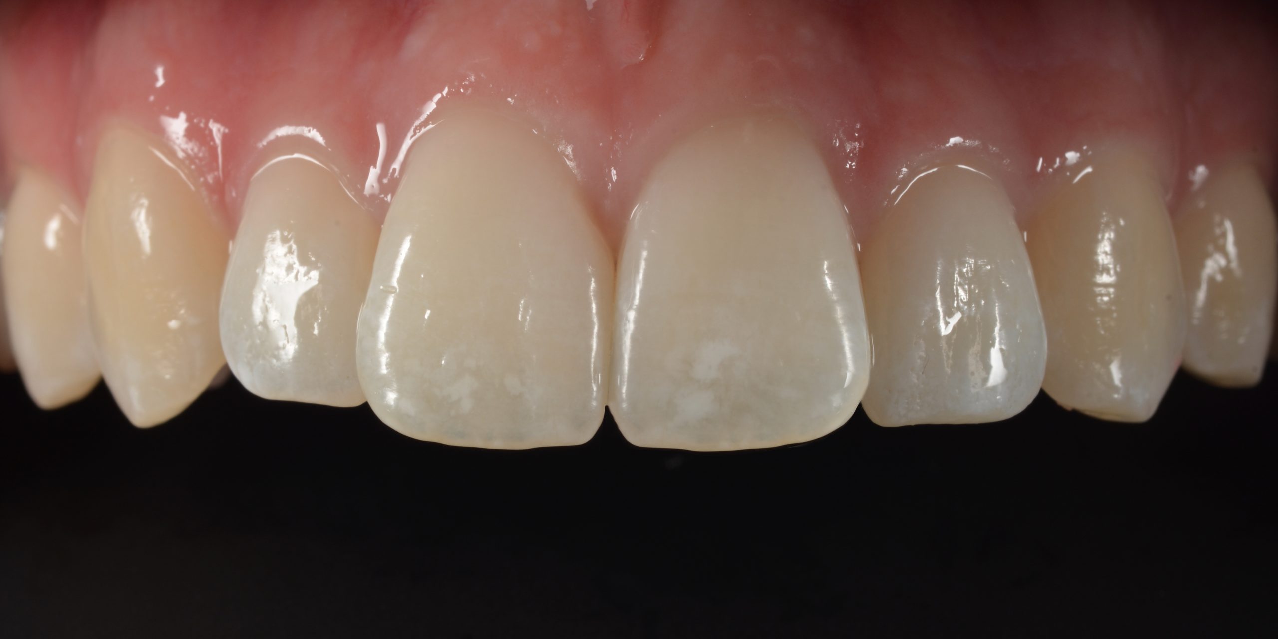 NEW TOOTH