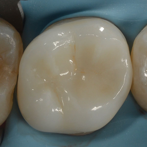 Ilfracombe_Crowns_Case_Study_Elite
