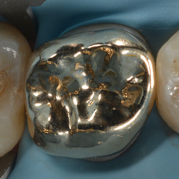 Ilfracombe_Crowns_Case_Study_Gold