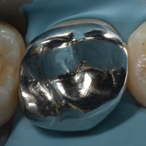 Ilfracombe_Crowns_Case_Study_Gold_Alloy