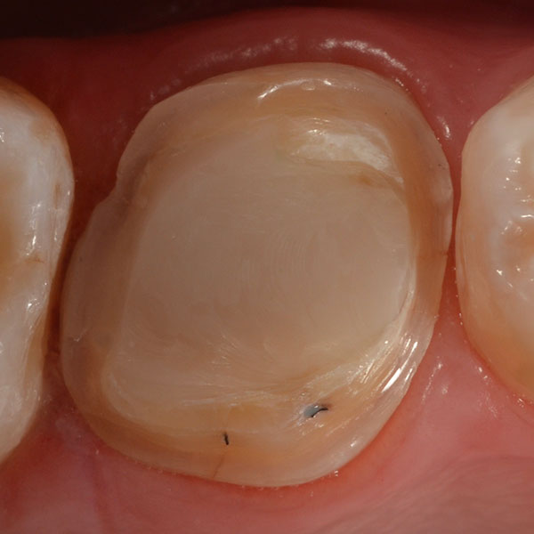 Ilfracombe_Crowns_Case_Study_Pic1