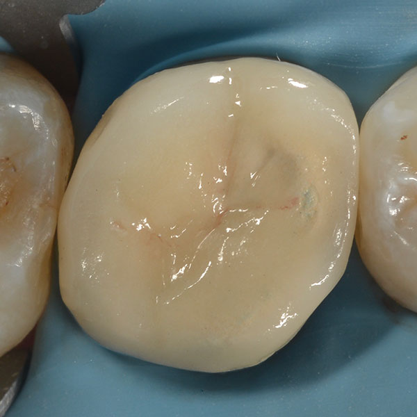 Ilfracombe_Crowns_Case_Study_Standard